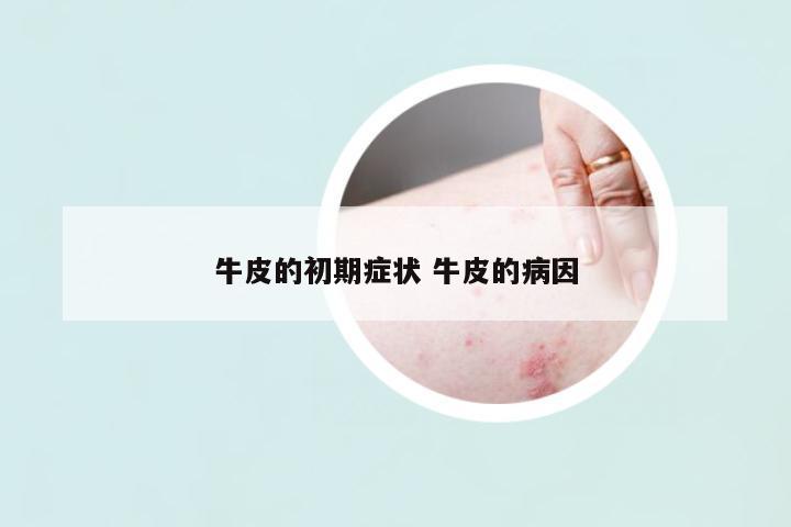 牛皮的初期癥狀 牛皮的病因