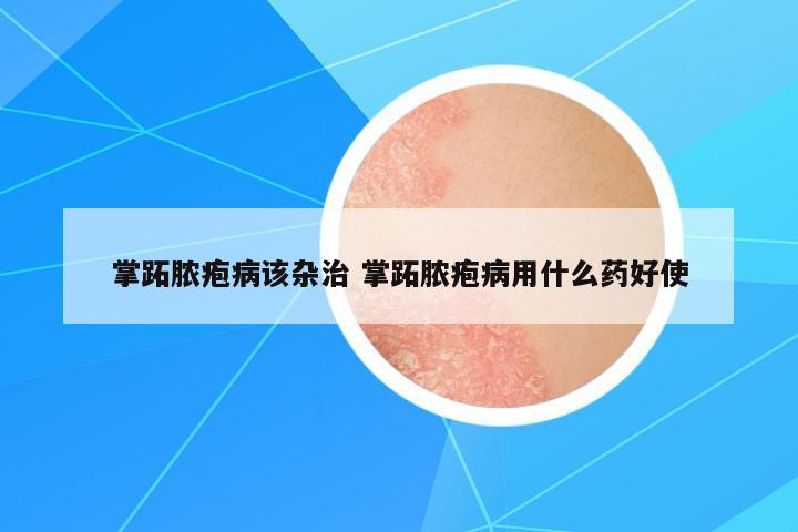 掌跖膿皰病該雜治 掌跖膿皰病用什么藥好使