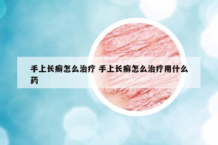 手上長癬怎么治療 手上長癬怎么治療用什么藥