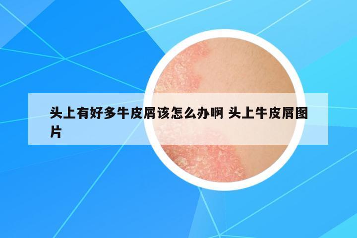 頭上有好多牛皮屑該怎么辦啊 頭上牛皮屑圖片