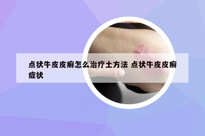 點狀牛皮皮癬怎么治療土方法 點狀牛皮皮癬癥狀