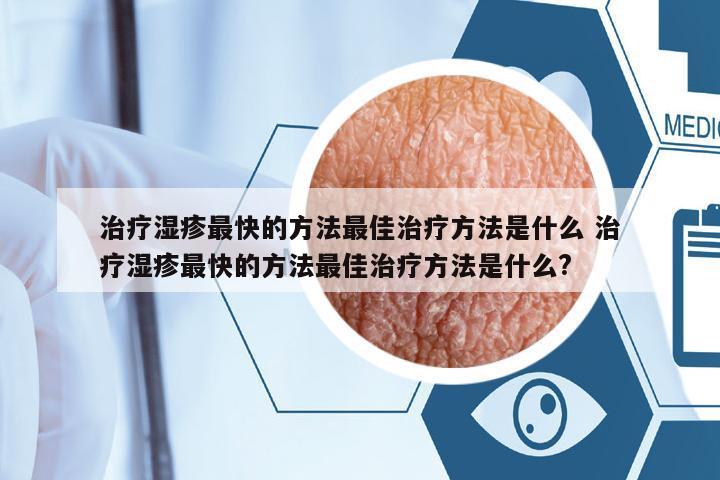 治療濕疹最快的方法最佳治療方法是什么 治療濕疹最快的方法最佳治療方法是什么?