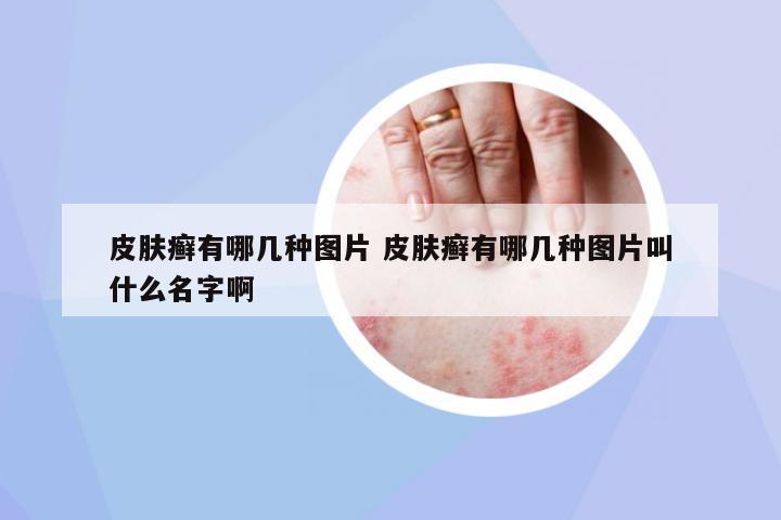 皮膚癬有哪幾種圖片 皮膚癬有哪幾種圖片叫什么名字啊