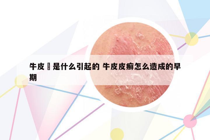 牛皮癬是什么引起的 牛皮皮癬怎么造成的早期
