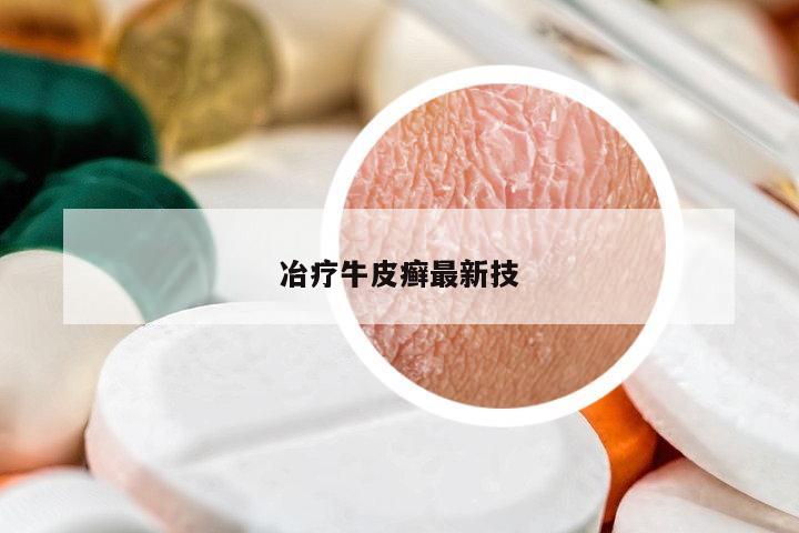 冶療牛皮癬最新技