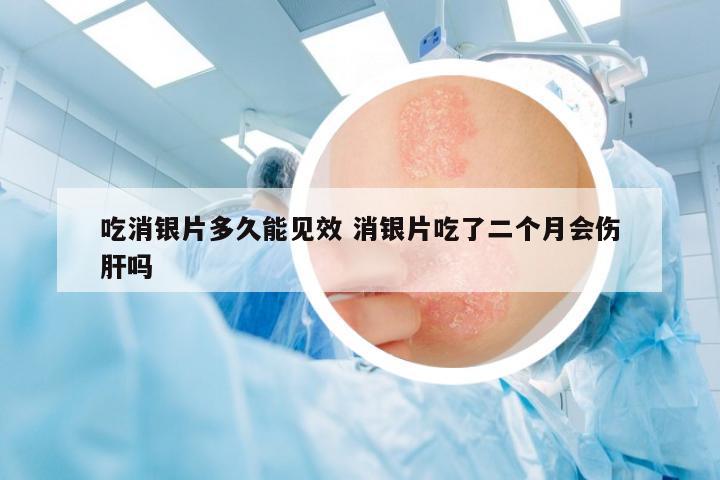 吃消銀片多久能見效 消銀片吃了二個(gè)月會(huì)傷肝嗎
