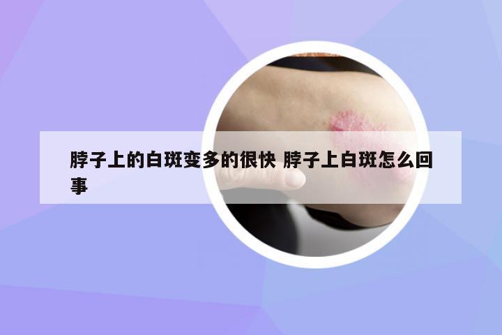 脖子上的白斑變多的很快 脖子上白斑怎么回事