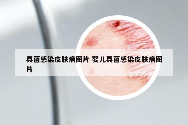 真菌感染皮膚病圖片 嬰兒真菌感染皮膚病圖片