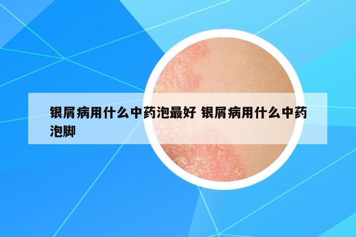 銀屑病用什么中藥泡最好 銀屑病用什么中藥泡腳