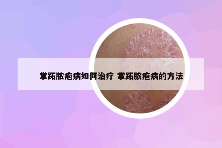 掌跖膿皰病如何治療 掌跖膿皰病的方法