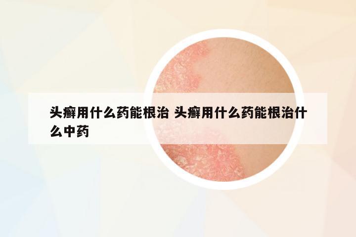 頭癬用什么藥能根治 頭癬用什么藥能根治什么中藥