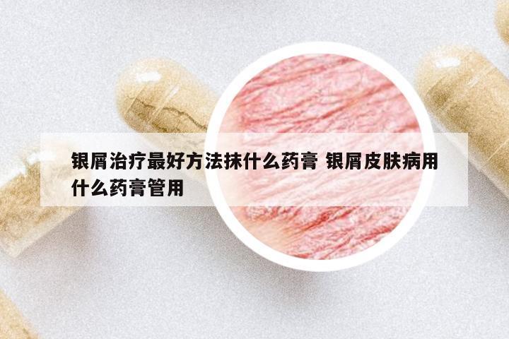 銀屑治療最好方法抹什么藥膏 銀屑皮膚病用什么藥膏管用