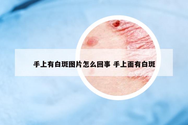 手上有白斑圖片怎么回事 手上面有白斑