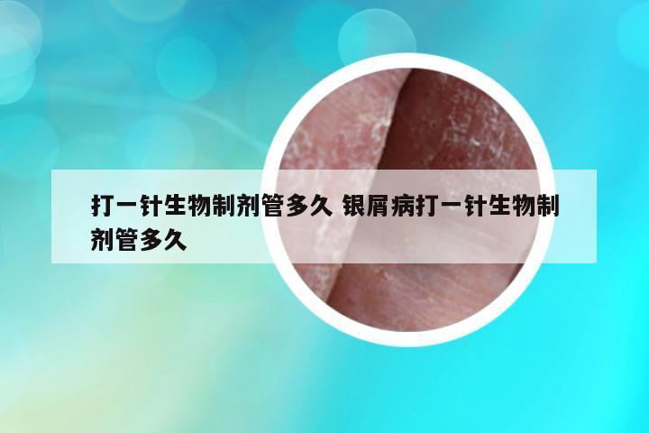 打一針生物制劑管多久 銀屑病打一針生物制劑管多久