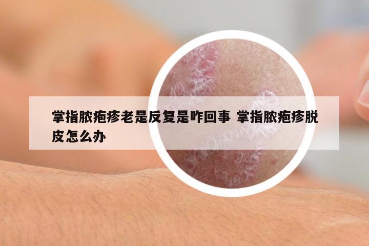 掌指膿皰疹老是反復(fù)是咋回事 掌指膿皰疹脫皮怎么辦
