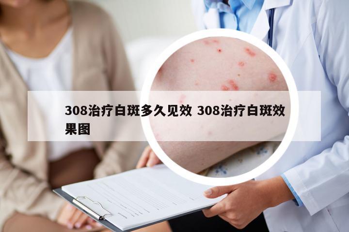 308治療白斑多久見效 308治療白斑效果圖