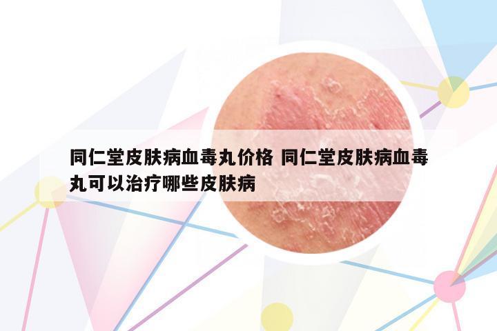 同仁堂皮膚病血毒丸價(jià)格 同仁堂皮膚病血毒丸可以治療哪些皮膚病