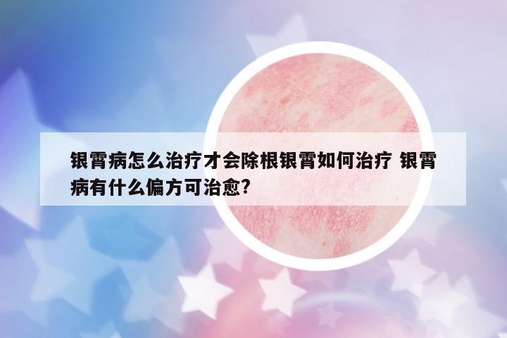 銀霄病怎么治療才會除根銀霄如何治療 銀霄病有什么偏方可治愈?