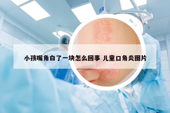 小孩嘴角白了一塊怎么回事 兒童口角炎圖片