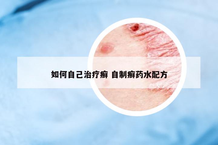 如何自己治療癬 自制癬藥水配方