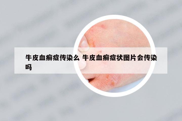 牛皮血癬癥傳染么 牛皮血癬癥狀圖片會傳染嗎