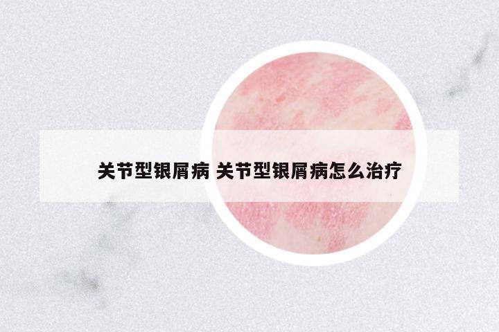 關(guān)節(jié)型銀屑病 關(guān)節(jié)型銀屑病怎么治療