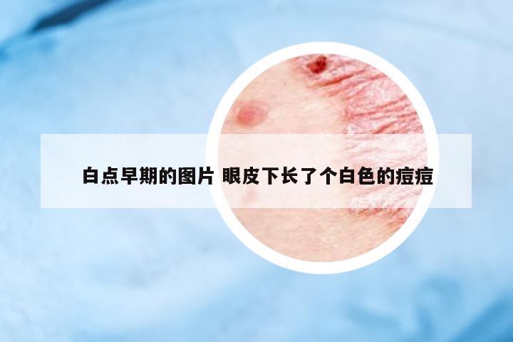 白點早期的圖片 眼皮下長了個白色的痘痘