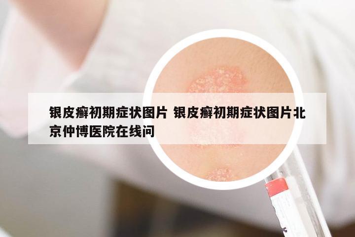 銀皮癬初期癥狀圖片 銀皮癬初期癥狀圖片北京仲博醫(yī)院在線問