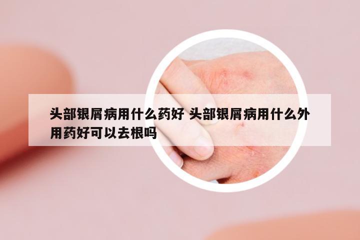 頭部銀屑病用什么藥好 頭部銀屑病用什么外用藥好可以去根嗎