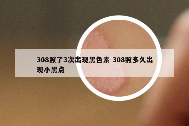 308照了3次出現(xiàn)黑色素 308照多久出現(xiàn)小黑點