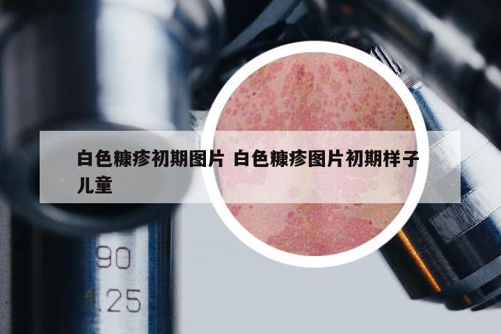 白色糠疹初期圖片 白色糠疹圖片初期樣子 兒童