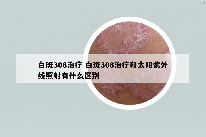 白斑308治療 白斑308治療和太陽(yáng)紫外線照射有什么區(qū)別
