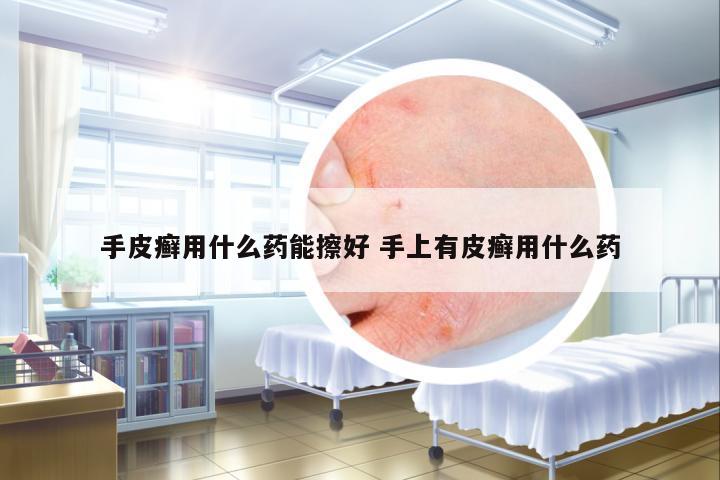 手皮癬用什么藥能擦好 手上有皮癬用什么藥