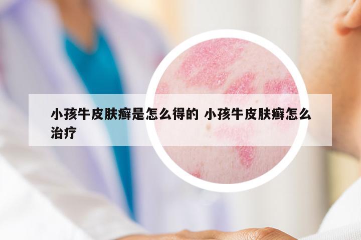 小孩牛皮膚癬是怎么得的 小孩牛皮膚癬怎么治療
