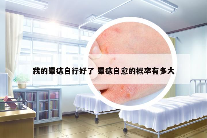 我的暈痣自行好了 暈痣自愈的概率有多大