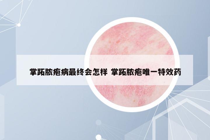 掌跖膿皰病最終會怎樣 掌跖膿皰唯一特效藥