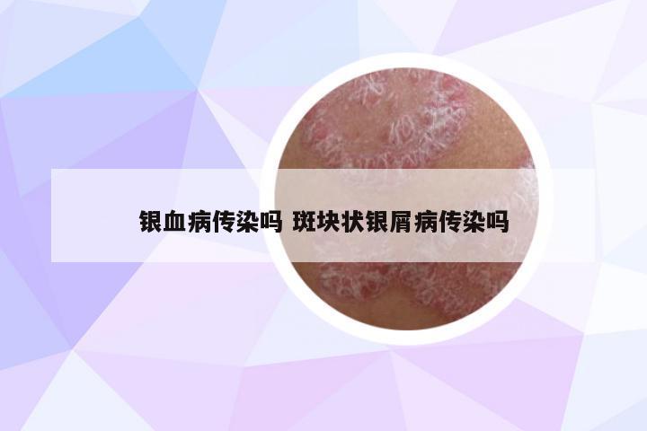 銀血病傳染嗎 斑塊狀銀屑病傳染嗎