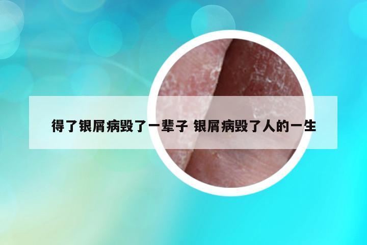 得了銀屑病毀了一輩子 銀屑病毀了人的一生