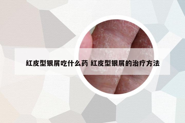 紅皮型銀屑吃什么藥 紅皮型銀屑的治療方法
