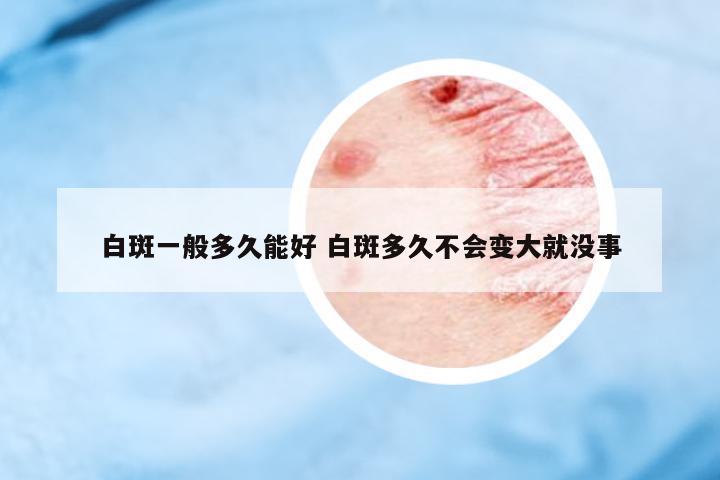 白斑一般多久能好 白斑多久不會變大就沒事