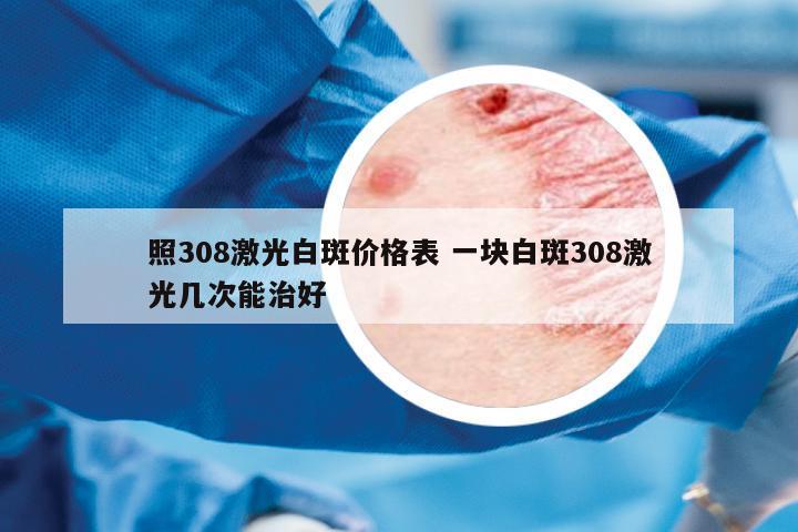 照308激光白斑價(jià)格表 一塊白斑308激光幾次能治好