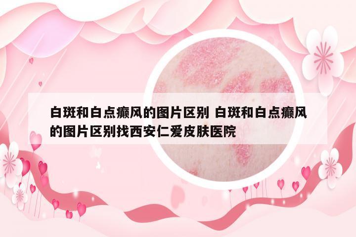 白斑和白點癲風的圖片區(qū)別 白斑和白點癲風的圖片區(qū)別找西安仁愛皮膚醫(yī)院