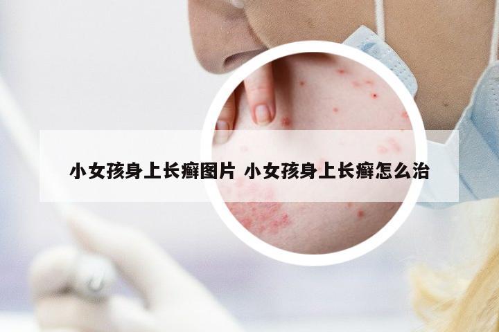 小女孩身上長(zhǎng)癬圖片 小女孩身上長(zhǎng)癬怎么治