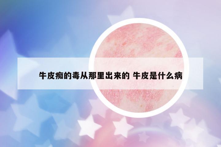 牛皮癡的毒從那里出來的 牛皮是什么病