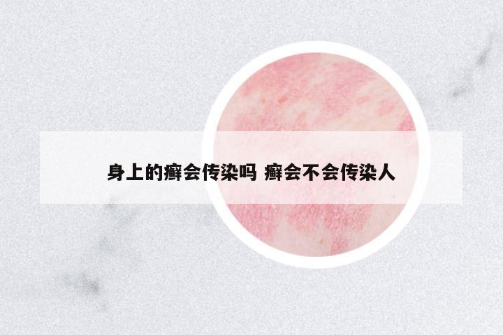 身上的癬會傳染嗎 癬會不會傳染人