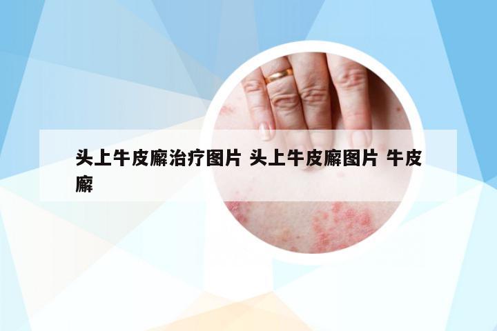 頭上牛皮廨治療圖片 頭上牛皮廨圖片 牛皮廨