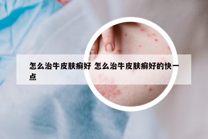 怎么治牛皮膚癬好 怎么治牛皮膚癬好的快一點