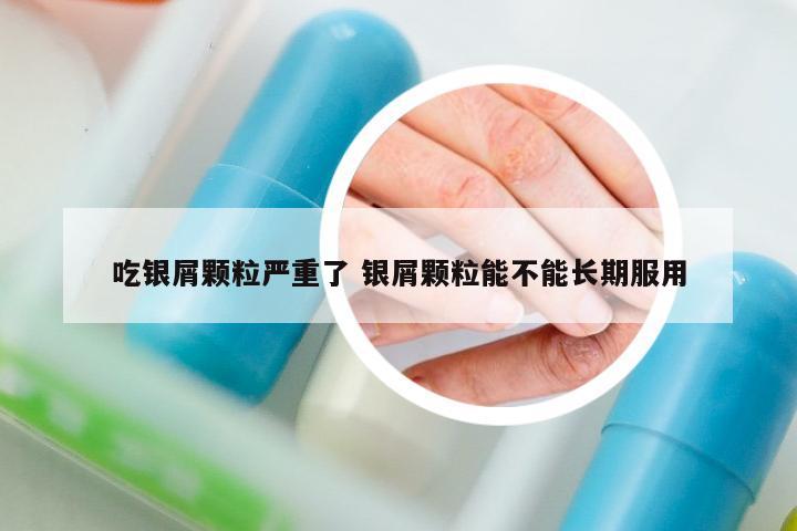 吃銀屑顆粒嚴重了 銀屑顆粒能不能長期服用