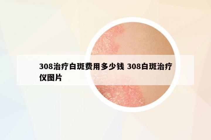 308治療白斑費(fèi)用多少錢 308白斑治療儀圖片