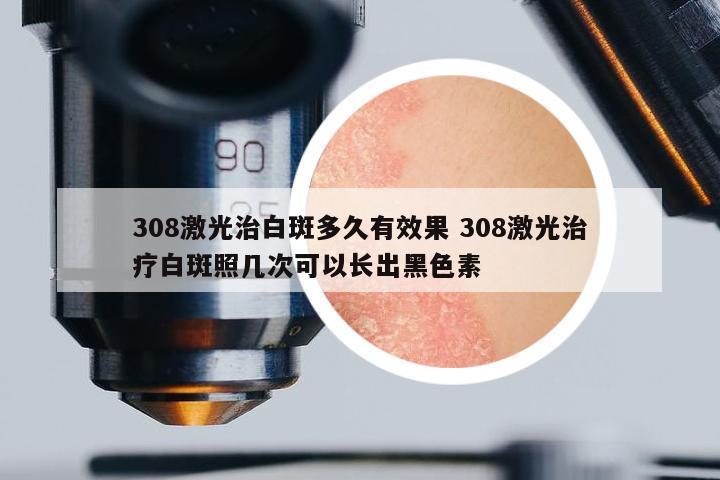 308激光治白斑多久有效果 308激光治療白斑照幾次可以長出黑色素